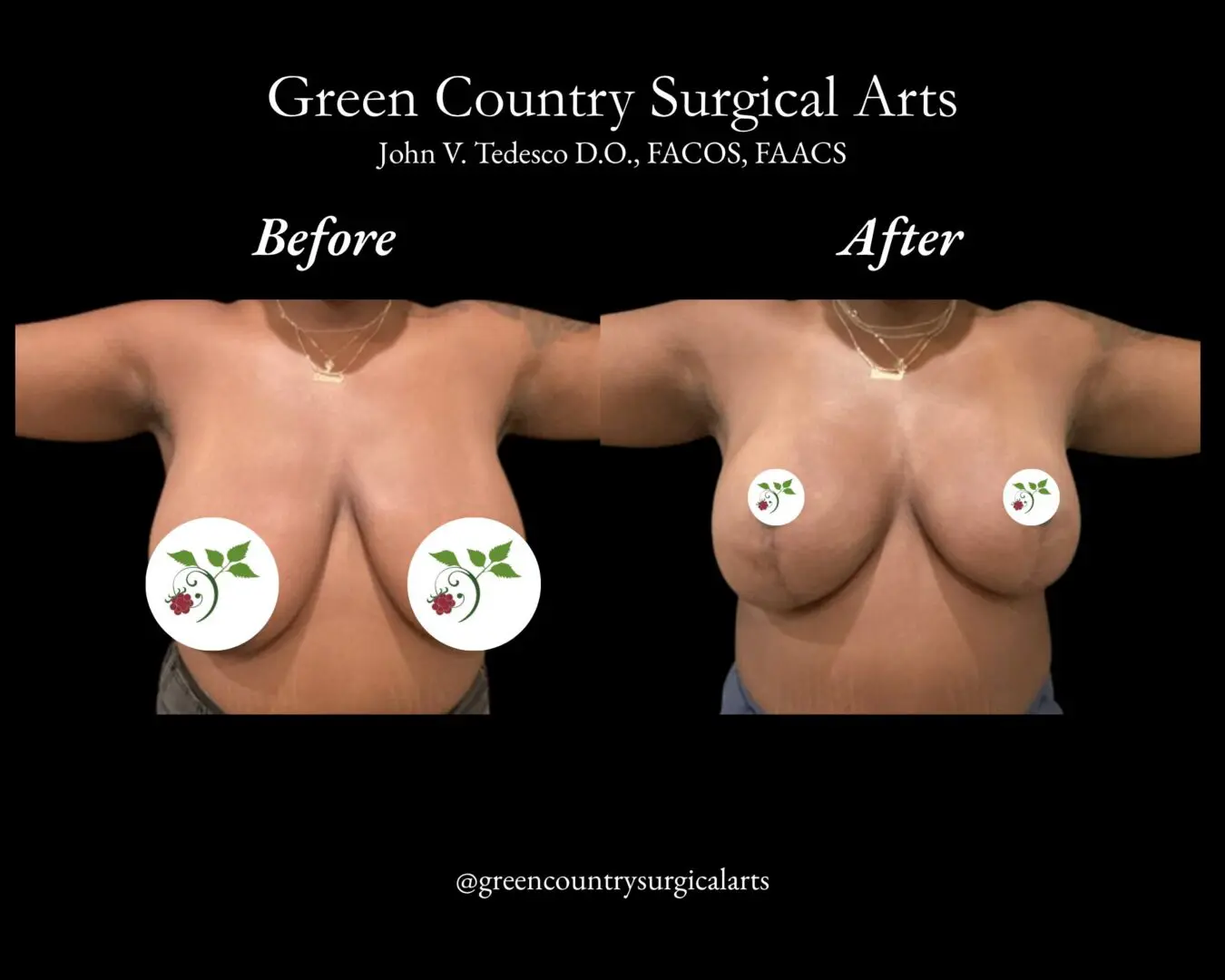 Frontal preoperative and postoperative chest transformation