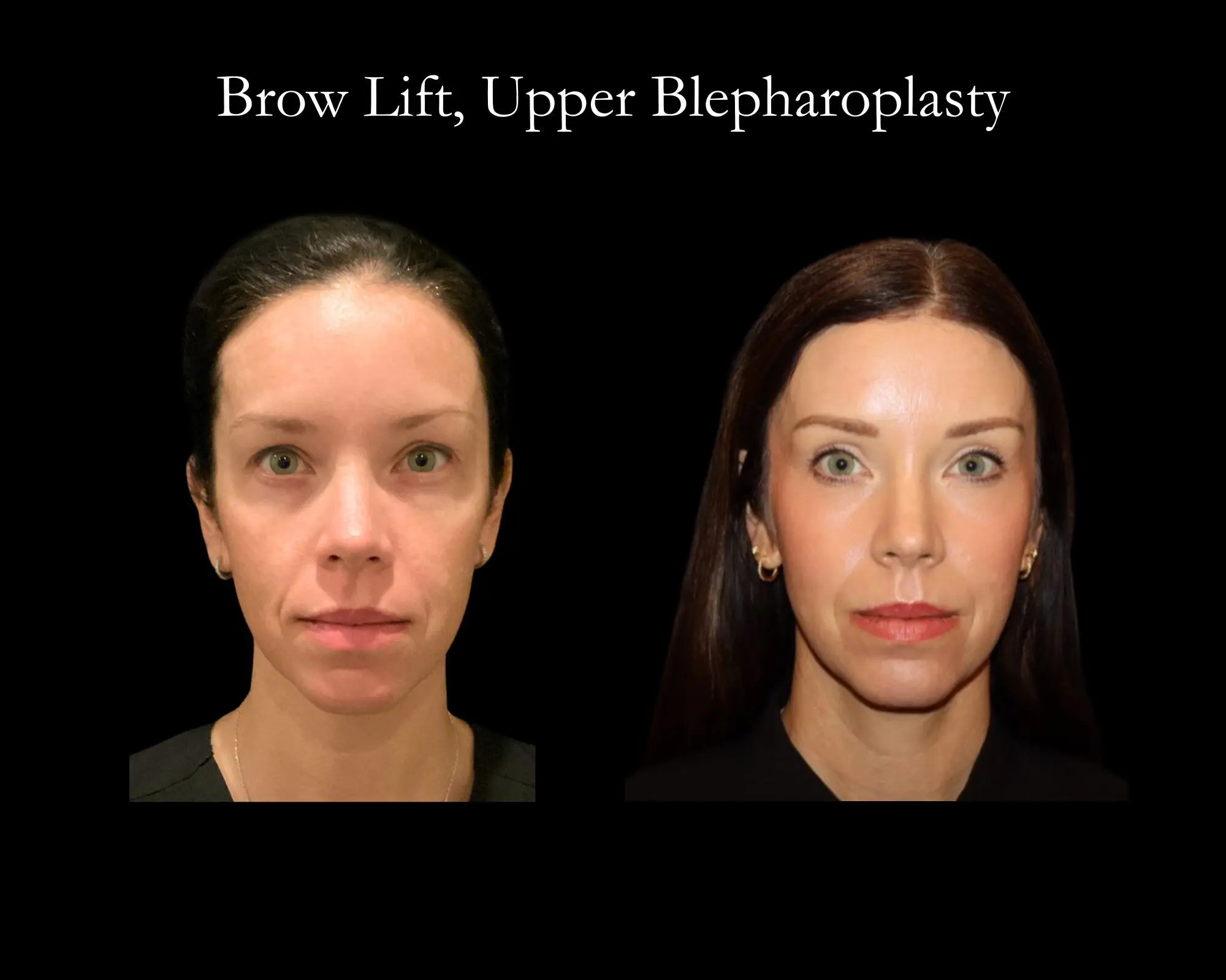 69de8f7975151_BeforeAfter Facial Surgery (5)