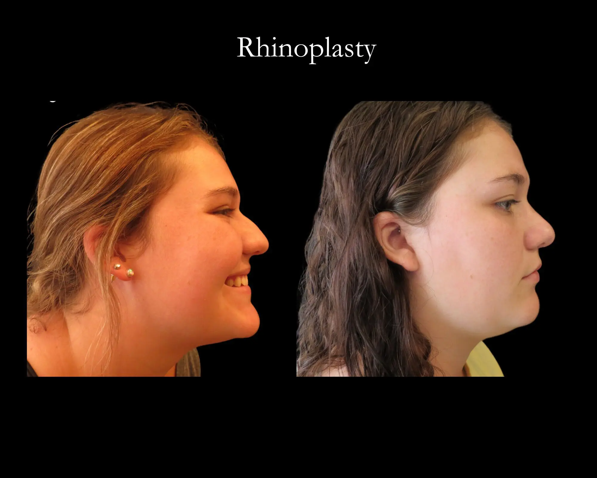 69de901d1f774_BeforeAfter Facial Surgery (6)