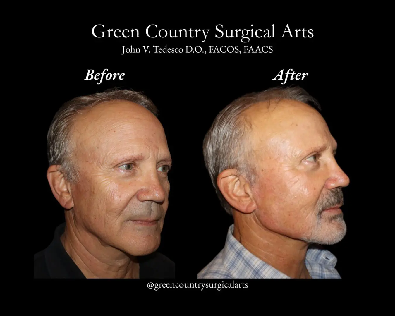 Before and after male facelift profile