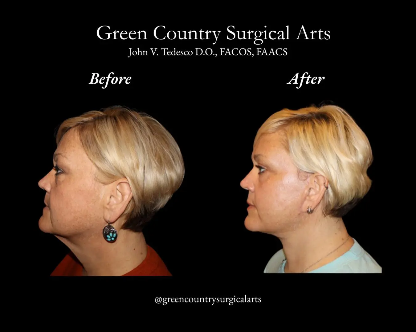 Side-by-side before and after facelift profiles