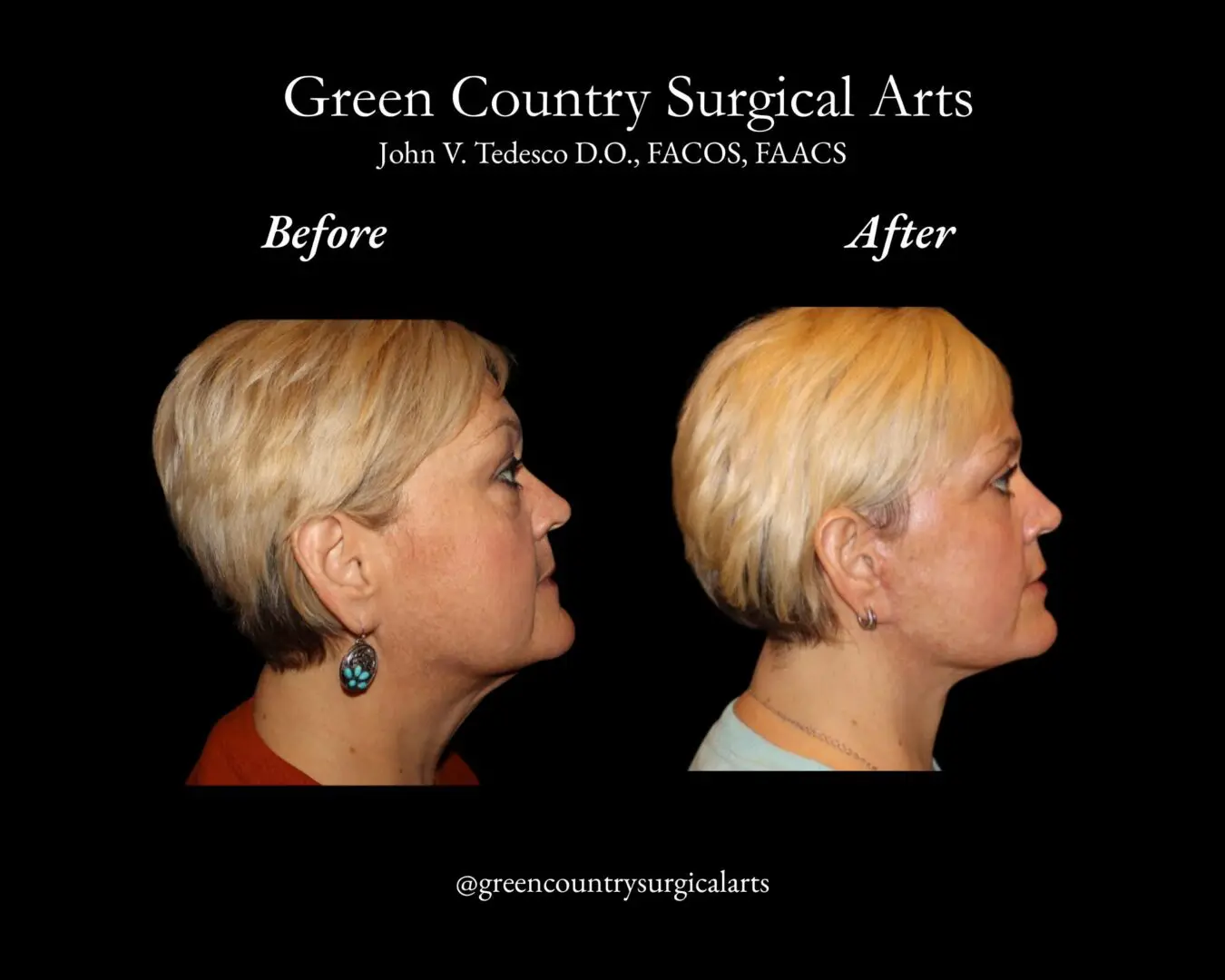 Before and after facial profile photos of woman