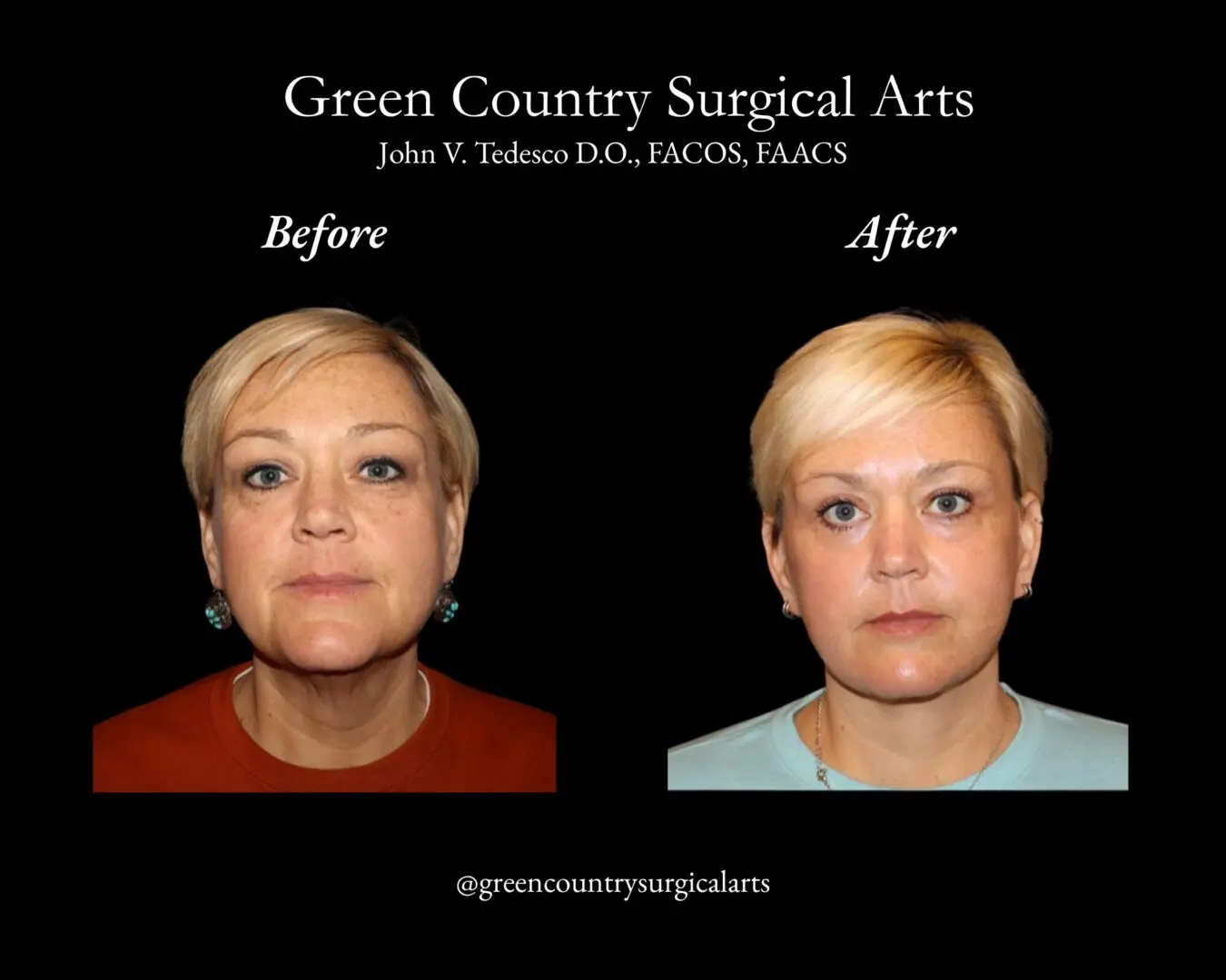Before and after facial surgery comparison